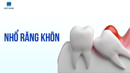 Nhổ Răng Khôn